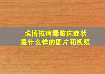 埃博拉病毒临床症状是什么样的图片和视频