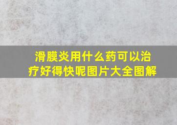 滑膜炎用什么药可以治疗好得快呢图片大全图解