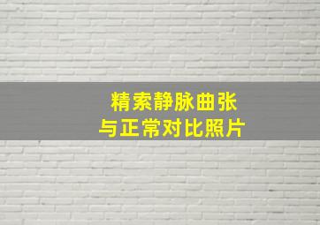 精索静脉曲张与正常对比照片