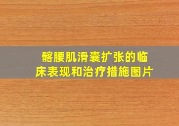 髂腰肌滑囊扩张的临床表现和治疗措施图片