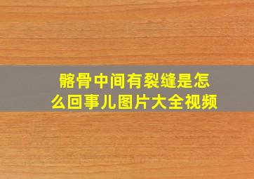 髂骨中间有裂缝是怎么回事儿图片大全视频